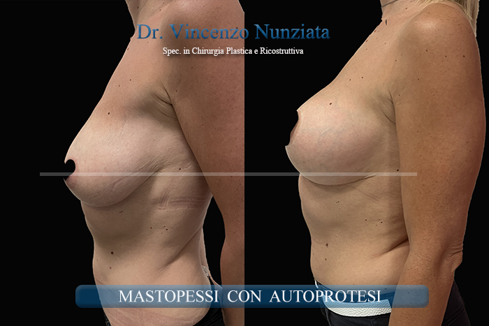 Mastopessi prima e dopo – Paziente 13 – Dr. Vincenzo Nunziata, chirurgo plastico – foto 2
