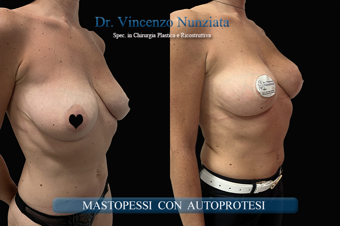 Mastopessi prima e dopo – Paziente 13 – Dr. Vincenzo Nunziata, chirurgo plastico – foto 4