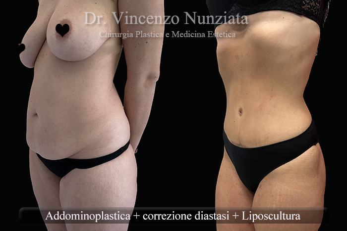 Addominoplastica prima e dopo – Paziente 28 – Dr. Vincenzo Nunziata, chirurgo plastico – foto 3