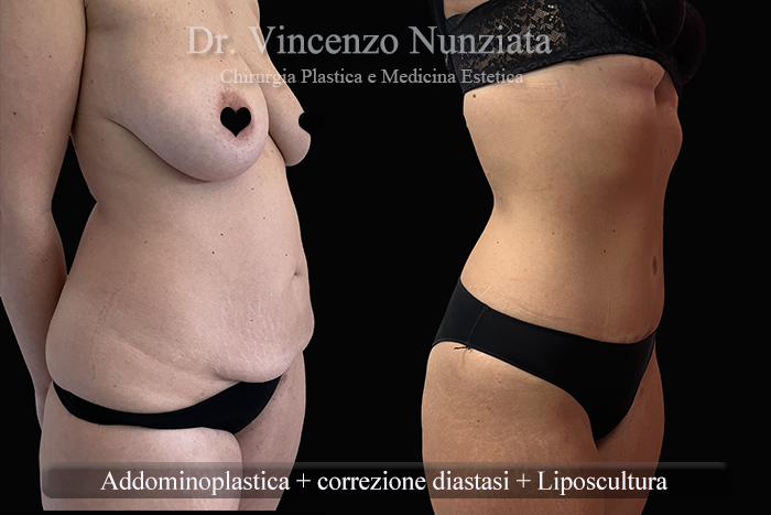 Addominoplastica prima e dopo – Paziente 28 – Dr. Vincenzo Nunziata, chirurgo plastico – foto 2
