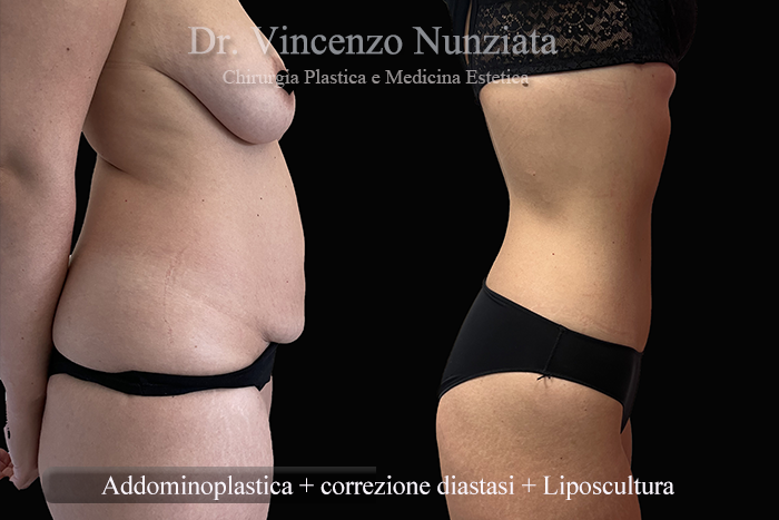 Addominoplastica prima e dopo – Paziente 28 – Dr. Vincenzo Nunziata, chirurgo plastico – foto 4