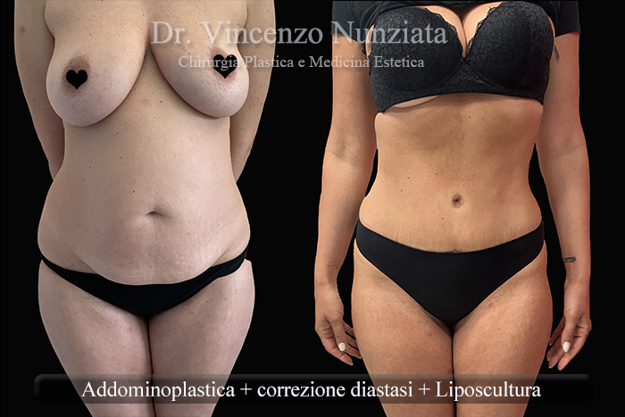 Addominoplastica prima e dopo – Paziente 28 – Dr. Vincenzo Nunziata, chirurgo plastico – foto 1