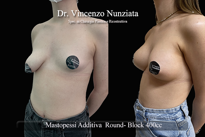 Asimmetrie mammarie prima e dopo – Paziente 10 – Dr. Vincenzo Nunziata, chirurgo plastico – foto 3