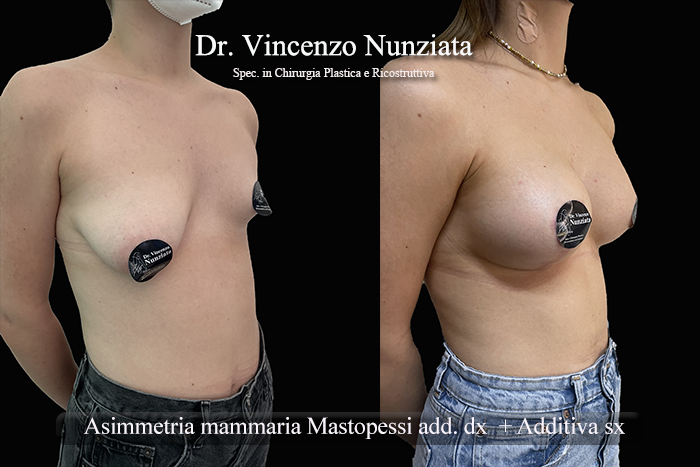 Asimmetrie mammarie prima e dopo – Paziente 10 – Dr. Vincenzo Nunziata, chirurgo plastico – foto 2