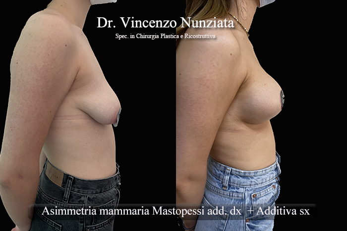 Asimmetrie mammarie prima e dopo – Paziente 10 – Dr. Vincenzo Nunziata, chirurgo plastico – foto 4