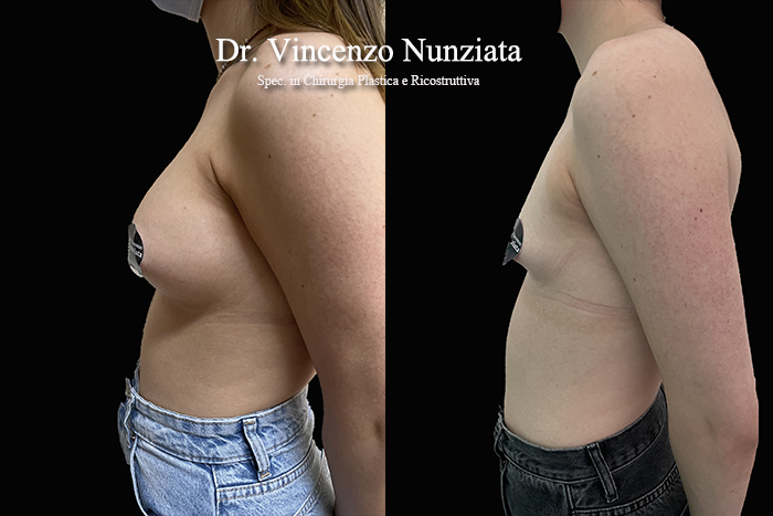 Asimmetrie mammarie prima e dopo – Paziente 10 – Dr. Vincenzo Nunziata, chirurgo plastico – foto 5