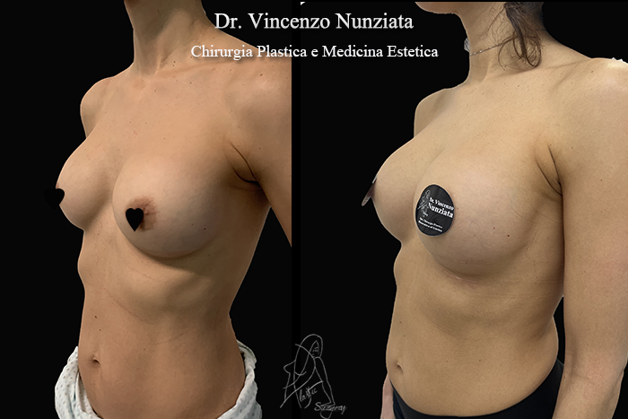 Revisioni mammarie prima e dopo – Paziente 11 – Dr. Vincenzo Nunziata, chirurgo plastico – foto 3