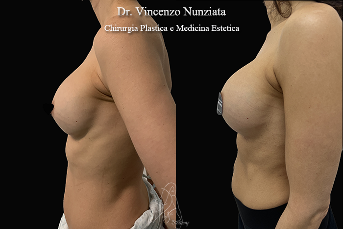 Revisioni mammarie prima e dopo – Paziente 11 – Dr. Vincenzo Nunziata, chirurgo plastico – foto 2