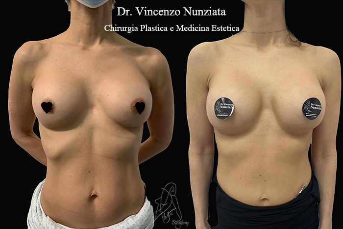 Revisioni mammarie prima e dopo – Paziente 11 – Dr. Vincenzo Nunziata, chirurgo plastico – foto 1