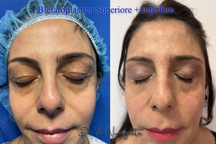 Blefaroplastica prima e dopo – Paziente 11 – Dr. Vincenzo Nunziata, chirurgo plastico – foto 3