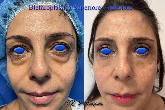 Blefaroplastica prima e dopo – Paziente 11 – Dr. Vincenzo Nunziata, chirurgo plastico – foto 1