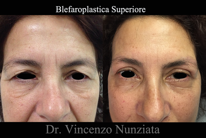 Blefaroplastica prima e dopo – Paziente 12 – Dr. Vincenzo Nunziata, chirurgo plastico – foto 2