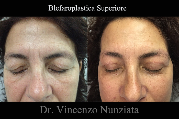 Blefaroplastica prima e dopo – Paziente 12 – Dr. Vincenzo Nunziata, chirurgo plastico – foto 1