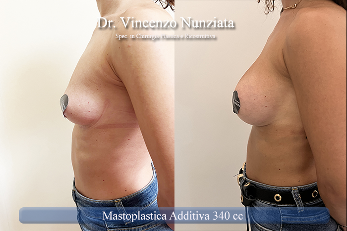 Mastoplastica additiva – protesi ergonomiche prima e dopo – Paziente 28 – Dr. Vincenzo Nunziata, chirurgo plastico – foto 2