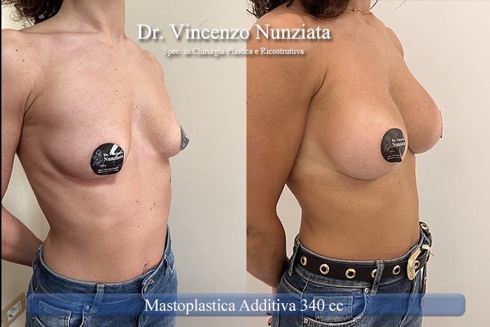 Mastoplastica additiva – protesi ergonomiche prima e dopo – Paziente 28 – Dr. Vincenzo Nunziata, chirurgo plastico – foto 4