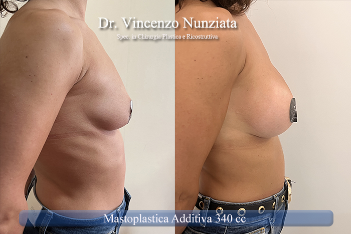 Mastoplastica additiva – protesi ergonomiche prima e dopo – Paziente 28 – Dr. Vincenzo Nunziata, chirurgo plastico – foto 3