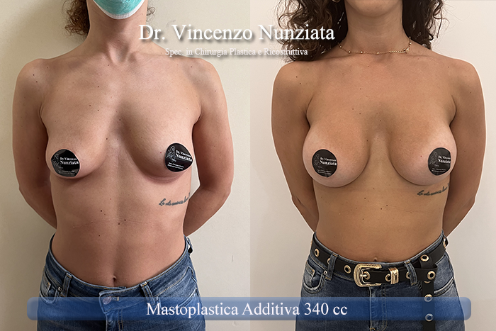 Mastoplastica additiva – protesi ergonomiche prima e dopo – Paziente 28 – Dr. Vincenzo Nunziata, chirurgo plastico – foto 1
