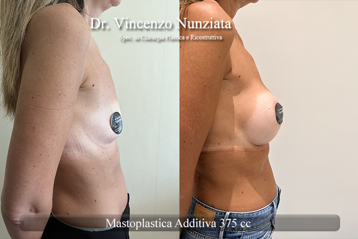 Mastoplastica additiva – protesi rotonde prima e dopo – Paziente 52 – Dr. Vincenzo Nunziata, chirurgo plastico – foto 3