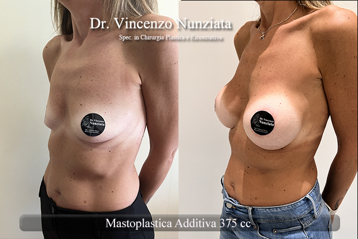 Mastoplastica additiva – protesi rotonde prima e dopo – Paziente 52 – Dr. Vincenzo Nunziata, chirurgo plastico – foto 2