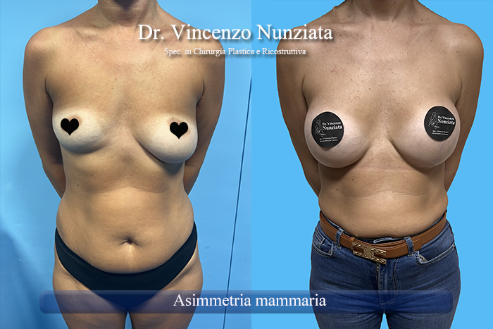 Asimmetrie mammarie prima e dopo – Paziente 11 – Dr. Vincenzo Nunziata, chirurgo plastico – foto 3