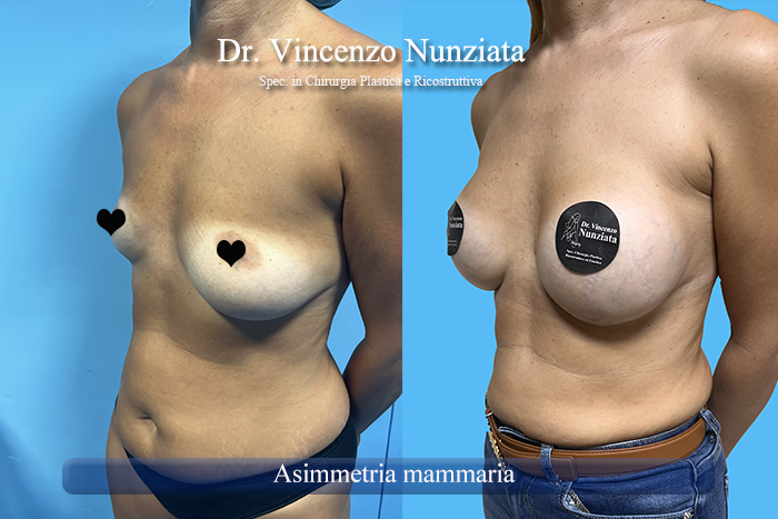 Asimmetrie mammarie prima e dopo – Paziente 11 – Dr. Vincenzo Nunziata, chirurgo plastico – foto 2