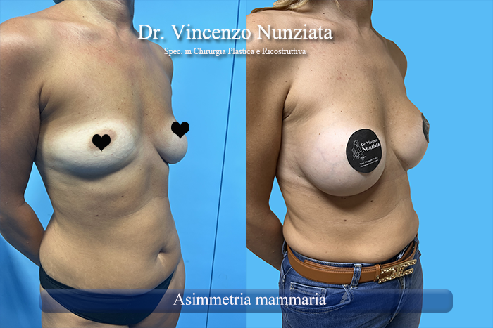 Asimmetrie mammarie prima e dopo – Paziente 11 – Dr. Vincenzo Nunziata, chirurgo plastico – foto 1