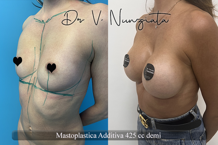 Mastoplastica additiva – protesi rotonde prima e dopo – Paziente 53 – Dr. Vincenzo Nunziata, chirurgo plastico – foto 3