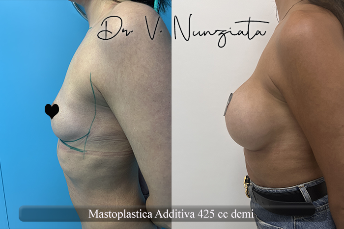 Mastoplastica additiva – protesi rotonde prima e dopo – Paziente 53 – Dr. Vincenzo Nunziata, chirurgo plastico – foto 2