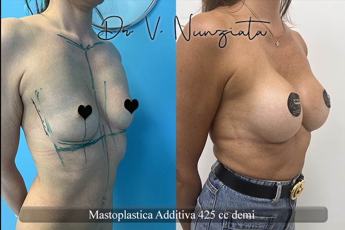 Mastoplastica additiva – protesi rotonde prima e dopo – Paziente 53 – Dr. Vincenzo Nunziata, chirurgo plastico – foto 4