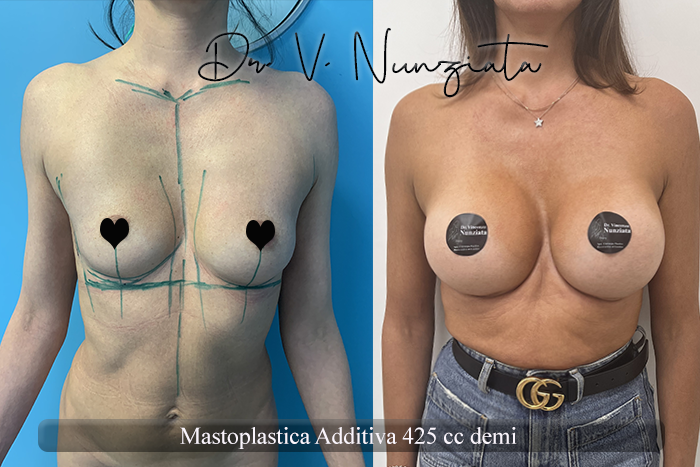 Mastoplastica additiva – protesi rotonde prima e dopo – Paziente 53 – Dr. Vincenzo Nunziata, chirurgo plastico – foto 1