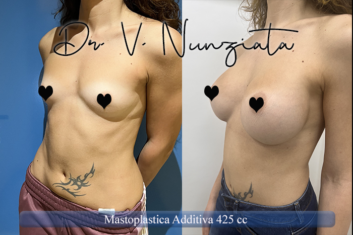 Mastoplastica additiva – protesi ergonomiche prima e dopo – Paziente 29 – Dr. Vincenzo Nunziata, chirurgo plastico – foto 3