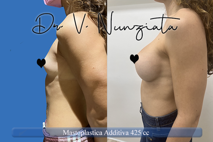 Mastoplastica additiva – protesi ergonomiche prima e dopo – Paziente 29 – Dr. Vincenzo Nunziata, chirurgo plastico – foto 2