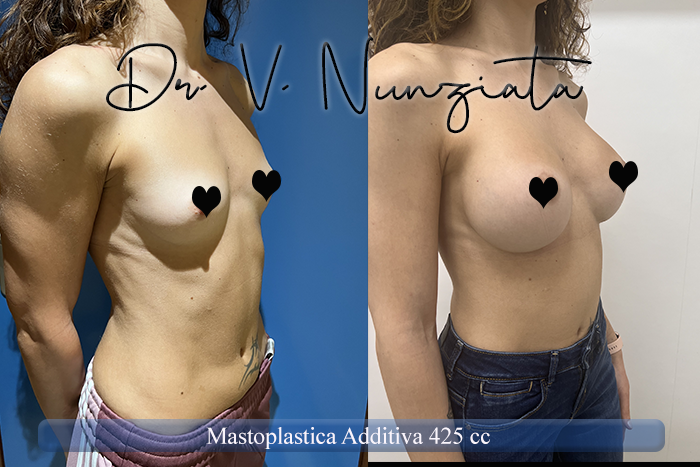 Mastoplastica additiva – protesi ergonomiche prima e dopo – Paziente 29 – Dr. Vincenzo Nunziata, chirurgo plastico – foto 4