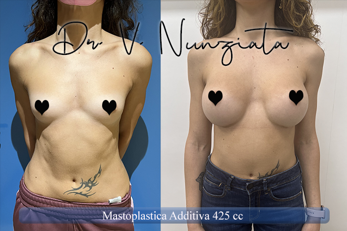 Mastoplastica additiva – protesi ergonomiche prima e dopo – Paziente 29 – Dr. Vincenzo Nunziata, chirurgo plastico – foto 1