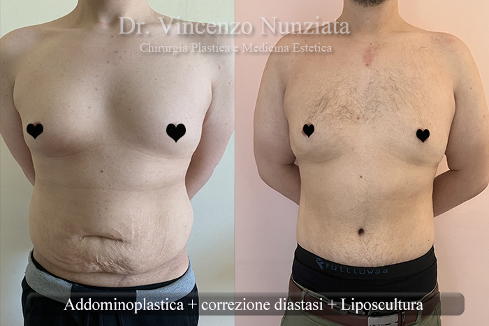 Addominoplastica prima e dopo – Paziente 29 – Dr. Vincenzo Nunziata, chirurgo plastico – foto 1