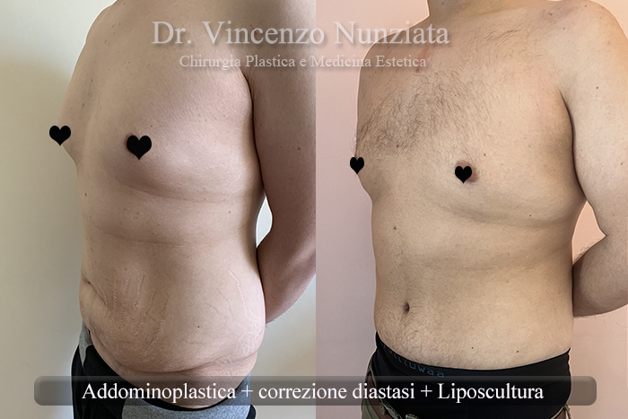 Addominoplastica prima e dopo – Paziente 29 – Dr. Vincenzo Nunziata, chirurgo plastico – foto 2