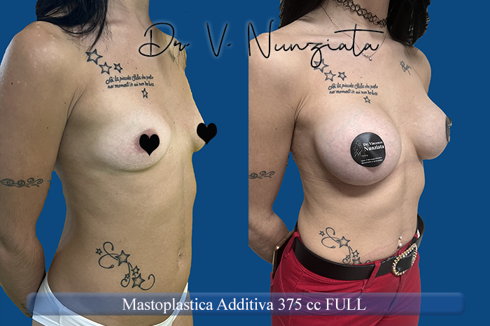 Mastoplastica additiva – protesi rotonde prima e dopo – Paziente 54 – Dr. Vincenzo Nunziata, chirurgo plastico – foto 2