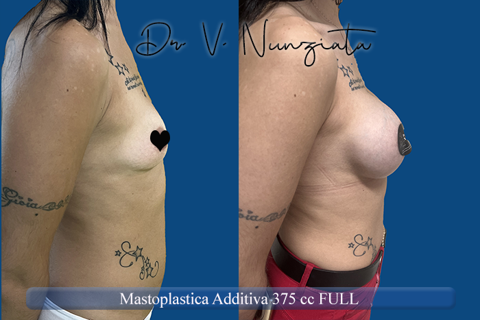 Mastoplastica additiva – protesi rotonde prima e dopo – Paziente 54 – Dr. Vincenzo Nunziata, chirurgo plastico – foto 3