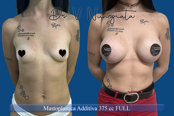 Mastoplastica additiva – protesi rotonde prima e dopo – Paziente 54 – Dr. Vincenzo Nunziata, chirurgo plastico – foto 1