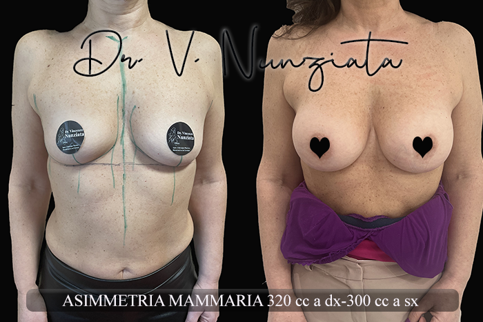 Mastoplastica additiva – protesi ergonomiche prima e dopo – Paziente 30 – Dr. Vincenzo Nunziata, chirurgo plastico – foto 1