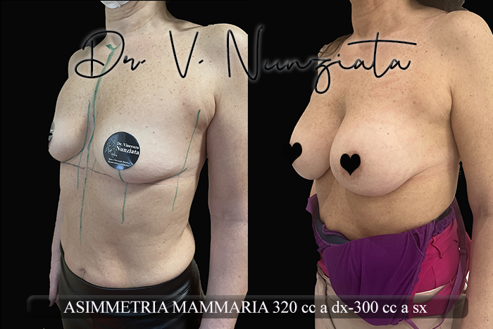 Mastoplastica additiva – protesi ergonomiche prima e dopo – Paziente 30 – Dr. Vincenzo Nunziata, chirurgo plastico – foto 3