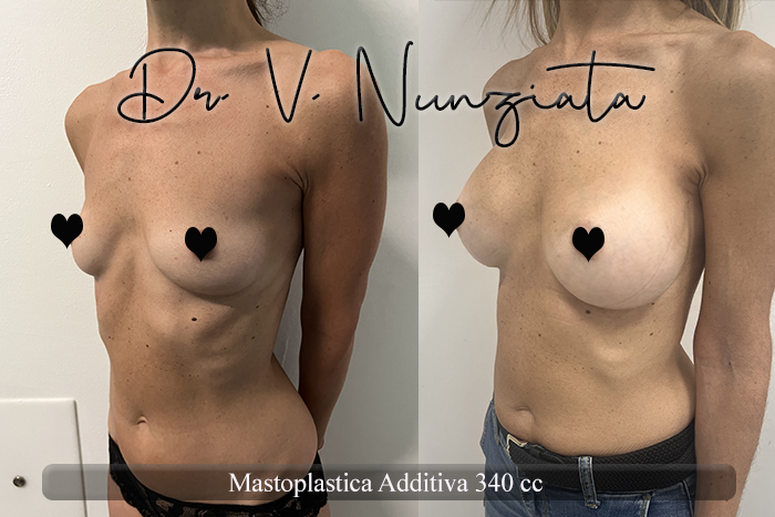 Mastoplastica additiva – protesi rotonde prima e dopo – Paziente 55 – Dr. Vincenzo Nunziata, chirurgo plastico – foto 2