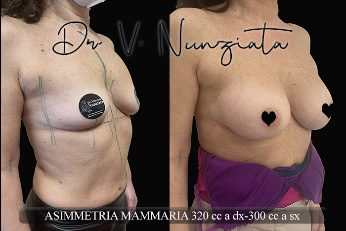 Mastoplastica additiva – protesi ergonomiche prima e dopo – Paziente 30 – Dr. Vincenzo Nunziata, chirurgo plastico – foto 2