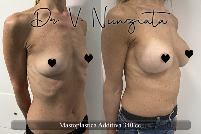 Mastoplastica additiva – protesi rotonde prima e dopo – Paziente 55 – Dr. Vincenzo Nunziata, chirurgo plastico – foto 4