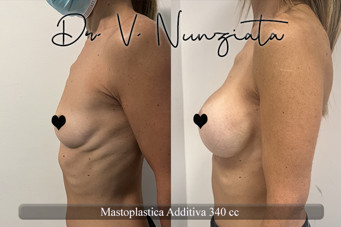 Mastoplastica additiva – protesi rotonde prima e dopo – Paziente 55 – Dr. Vincenzo Nunziata, chirurgo plastico – foto 3