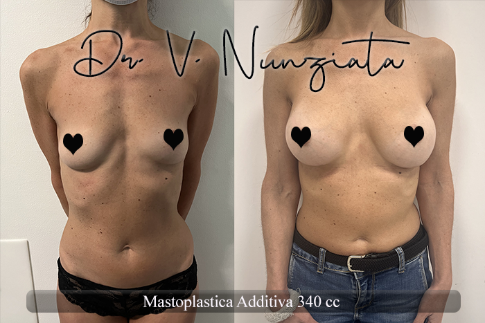 Mastoplastica additiva – protesi rotonde prima e dopo – Paziente 55 – Dr. Vincenzo Nunziata, chirurgo plastico – foto 1