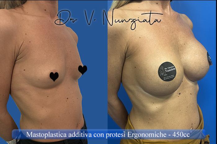 Mastoplastica additiva – protesi ergonomiche prima e dopo – Paziente 32 – Dr. Vincenzo Nunziata, chirurgo plastico – foto 2