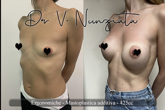 Mastoplastica additiva – protesi ergonomiche prima e dopo – Paziente 31 – Dr. Vincenzo Nunziata, chirurgo plastico – foto 1