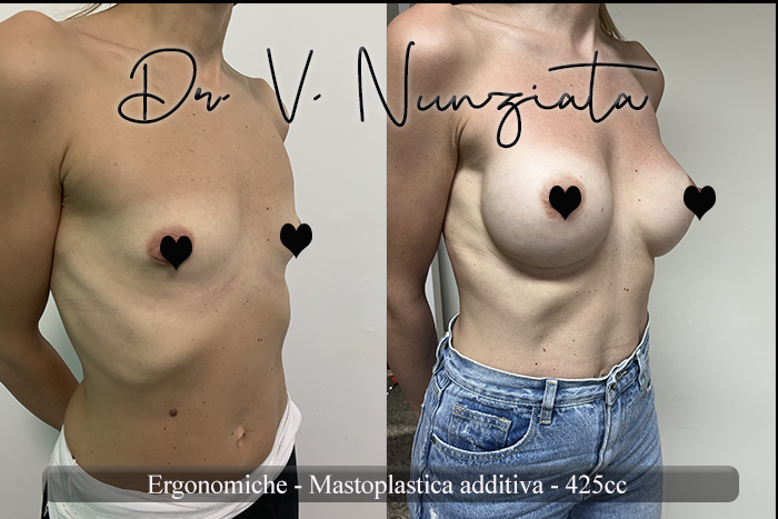 Mastoplastica additiva – protesi ergonomiche prima e dopo – Paziente 31 – Dr. Vincenzo Nunziata, chirurgo plastico – foto 3