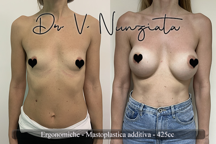 Mastoplastica additiva – protesi ergonomiche prima e dopo – Paziente 31 – Dr. Vincenzo Nunziata, chirurgo plastico – foto 2